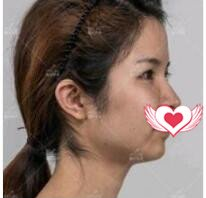 重庆美莱医美做激光祛斑案例分享!