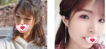 重庆美莱医美做激光祛斑案例分享!