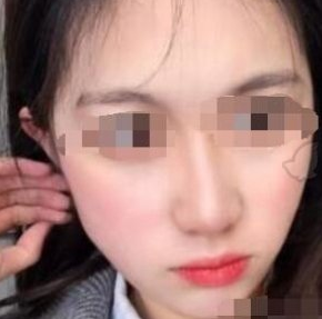 湖南长沙晶肤医美激光美肤案例分享!