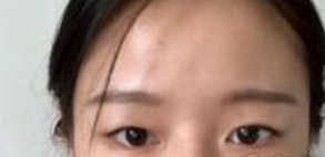 湖南长沙亚太医疗美容埋线双眼皮案例分享!