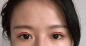 湖南长沙亚太医疗美容埋线双眼皮案例分享!