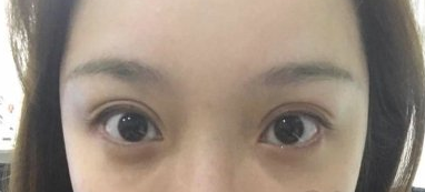 辽宁大连爱德丽格整形眼部修复术后120天分享!