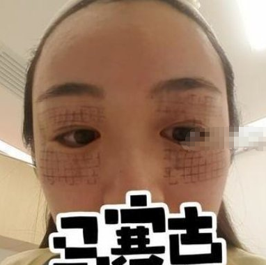 北京东方和谐医疗热玛吉除皱术后感受分享!
