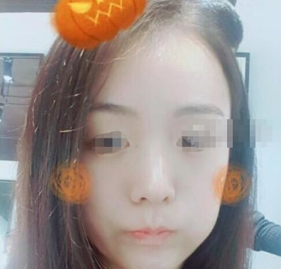 北京东方和谐医疗热玛吉除皱术后感受分享!