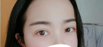 成都天使之翼医美切开双眼皮怎么样?