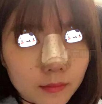南方医科大学珠江医院医生蒋海军鼻部手术术后