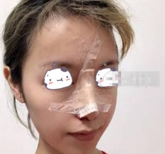 广州积美医美医生彭雷医生鼻部手术术后90天分享！