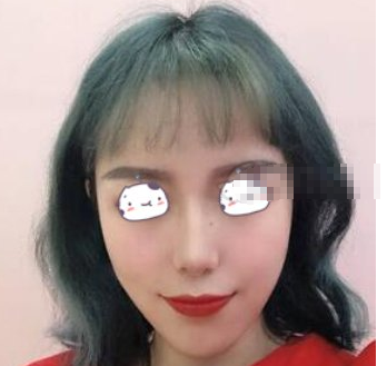 广州积美医美医生彭雷医生鼻部手术术后90天分享！