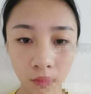 宁波友好医院整形科耳软骨隆鼻案例分享!