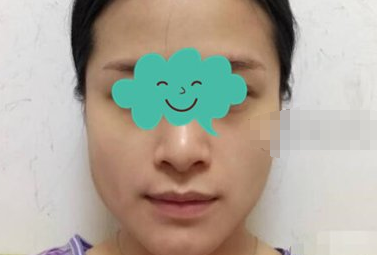 广州美恩医美医生徐威强下颌角切除果如何?