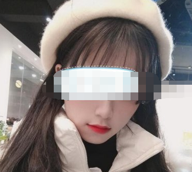 成都友谊医院医生张立天颧骨内推案例分享！