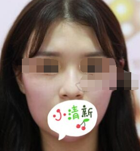 阜新安琪美医美医生何祯平鼻部手术案例