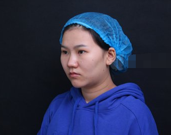 重庆军美医生董志勇肋软骨隆鼻案例分享!