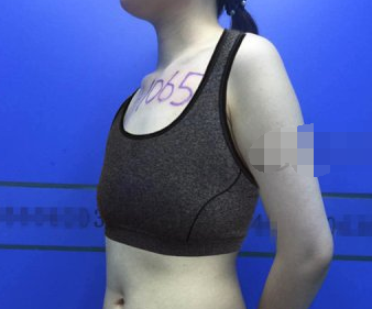 北京英煌医美医生梁耀婵自体脂肪隆胸果如何