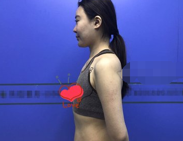 北京英煌医生梁耀婵做的隆胸果好吗？