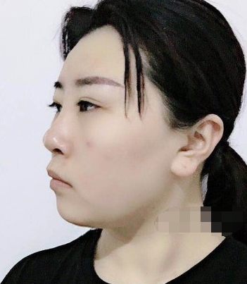 上海光博士医美医生彭春热玛吉果好不好?
