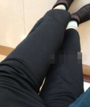 哈尔滨雅美医美大腿吸脂术后五十六天分享!
