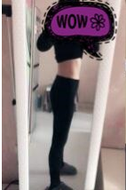 南京艺星医学医美腰腹吸脂术后两月分享!