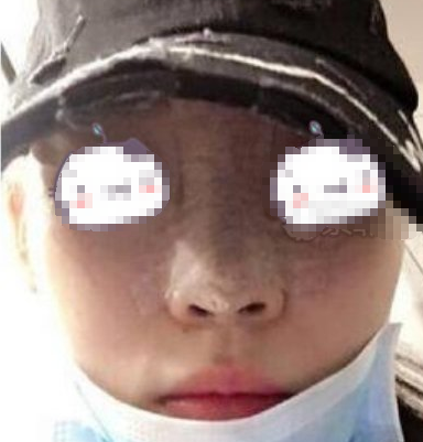 河南省人民医院美容科隆鼻术后一月分享!