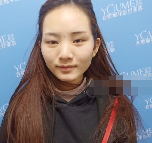 合肥福华自体脂肪全脸填充术后果分享