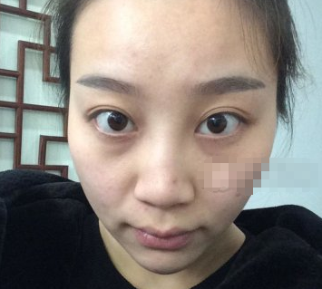 南昌红苹果美容医院鼻部手术术后果分享