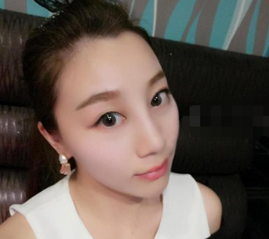 南昌红苹果美容医院鼻部手术术后果分享