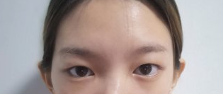沈阳沈河创美医疗美容医生张辉眼部手术案例分享