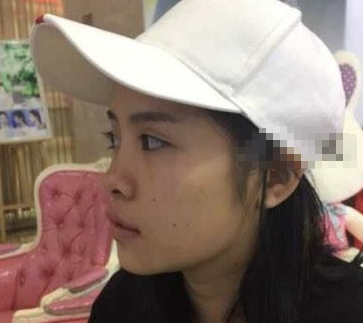重庆时光整形美容医院鼻部手术案例分享