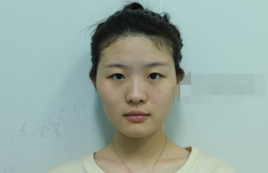 在长沙爱思特杨千里医生做的双眼皮果怎么样
