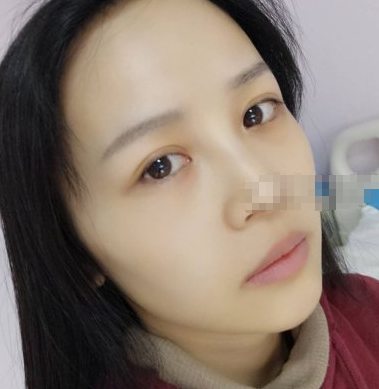 武汉美仑陈远海医生自脂丰苹果肌怎么样?