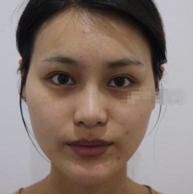 南昌小姐姐在红苹果医美丰的额头术后果分享