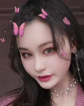 南昌小姐姐在红苹果医美丰的额头术后果分享