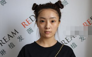 北京小姐姐在薇琳窦云轲医生种植发际线果
