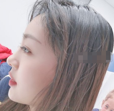 北京小姐姐在薇琳窦云轲医生种植发际线果