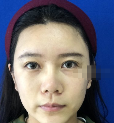 福州格莱美双眼皮怎么样?眼+鼻部手术案例分享