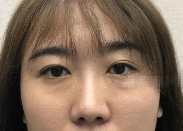北京中加科洋医美眶隔脂肪释放术后果如何?