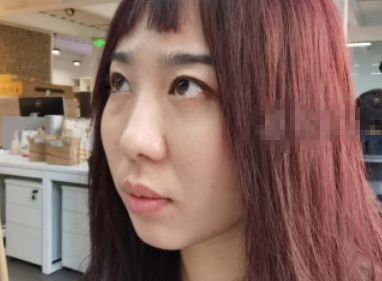 北京中加科洋医美眶隔脂肪释放术后果如何?