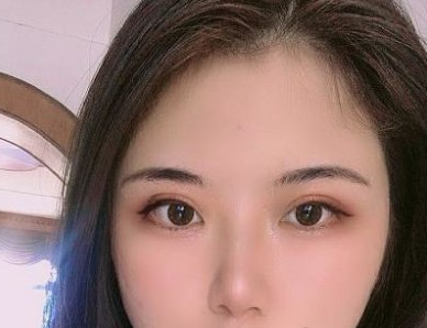 北京蜜邦医美怎样? 夏毓琴做的双眼皮果?