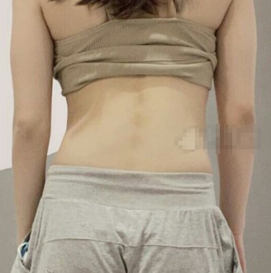 川妹在东篱医院张晓丽医生做的腰腹吸脂如何?