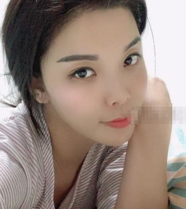 北京爱美者在画美医院白瓷娃娃术后果分享