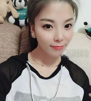北京爱美者在画美医院白瓷娃娃术后果分享