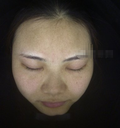重庆寻美者珂琳雅医美激光祛斑怎么样?