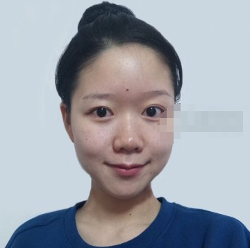 合肥华美祛斑可靠吗?妹子激光美肤术后分享