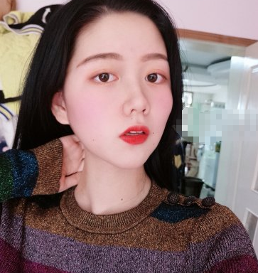 合肥华美祛斑可靠吗?妹子激光美肤术后分享