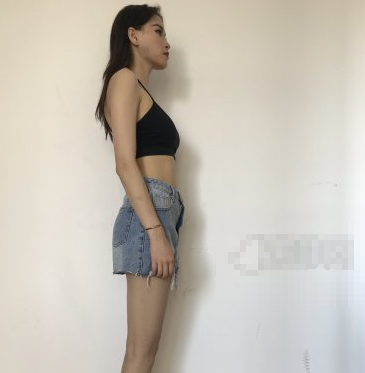 白领安琪儿医美如何?梁启春医生隆胸分享