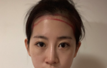 新生植发怎么样呢?南京妹纸植发新生了吗?
