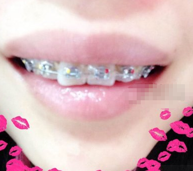托槽牙齿矫正案例有吗?深圳福华口腔医院如何