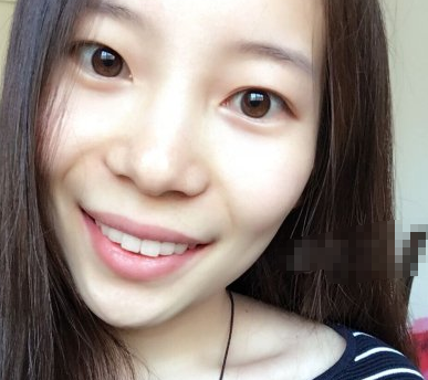 托槽牙齿矫正案例有吗?深圳福华口腔医院如何