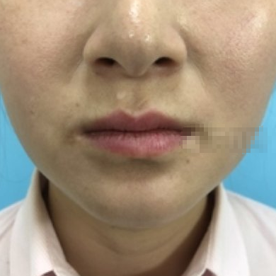 西安俪时代丰唇怎样?张洁医生丰唇案例分享