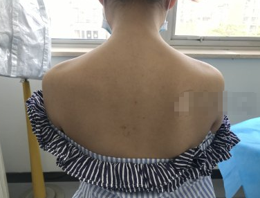 北京炫美岳莉冈注射注射瘦肩怎么样?